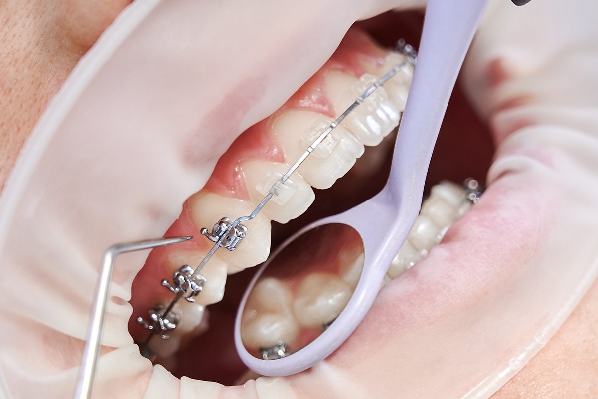 Ortodoncia en Tetuán Royal dental Clinic tetouan khaoula douiri