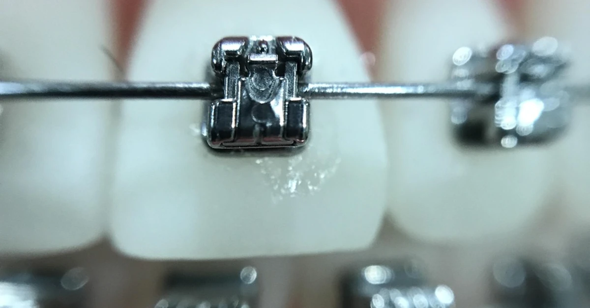 Comparaison entre des bagues en céramique et des aligners.